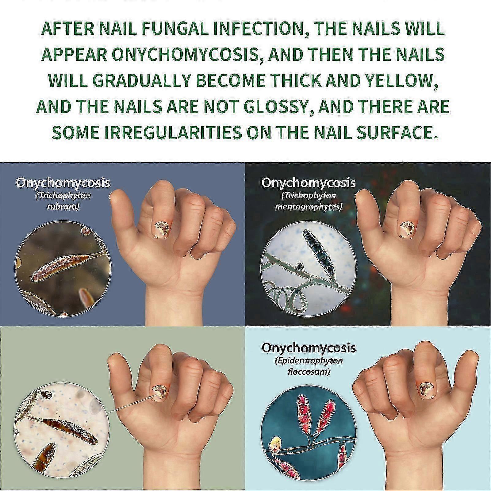 Fórmula de 7 dias para cuidados com as unhas com gengibre: hidrata as cutículas, trata fungos nas unhas e promove o crescimento