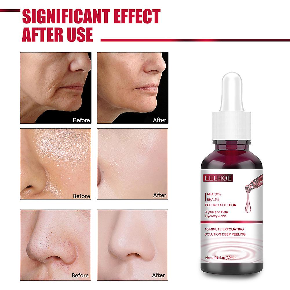 Skin Exfoliating Serums with 30% AHA & 2% BHA Anti-Acne Face Scrub Solution