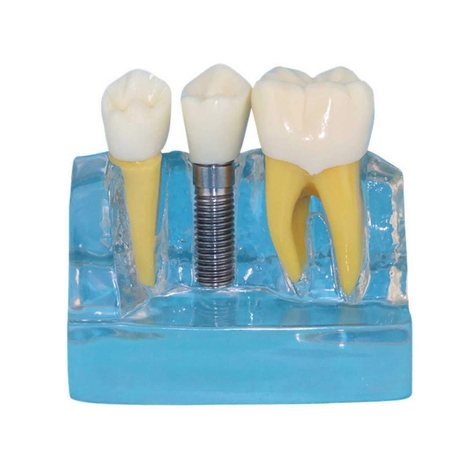 Dental Implant Model with Clear Visualization for Teaching and Patient Education Transparent Design