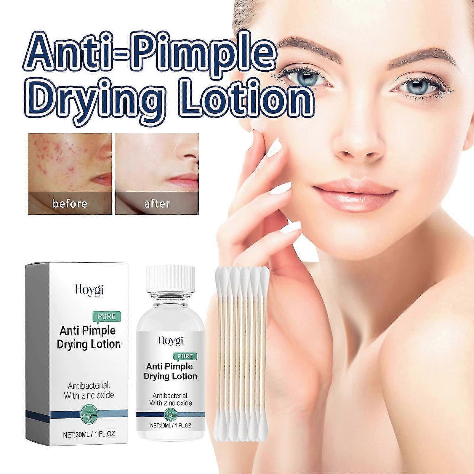 Anti-Pimple Drying Lotion, Spot Treatment with Zinc Oxide, AHA Lotion for Drying Pimples, Acne Spot Treatment Στεγνώνει τα σπυράκια