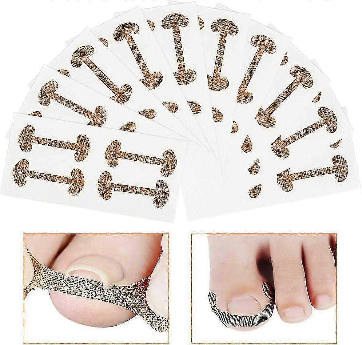 40 PCS Ingrown Toenail Corrector Stickers Breathable Self-Adhesive Elastic Toenail Correction Patch