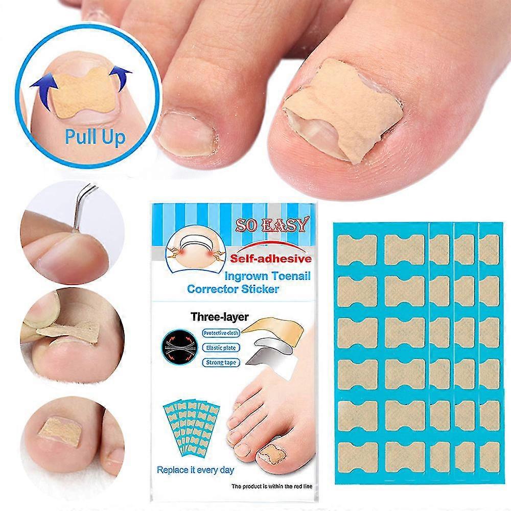 Nail Paste Ingrown Nail Paste Tape Ingrown Toenail Corrector Tool