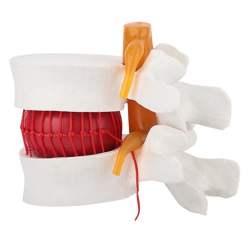 1:1.5 Human Lumbar Disc Herniation Medical Demonstration Model, Medical Demonstration Model Of Lumbar Vertebral Spine, for Linical Teaching