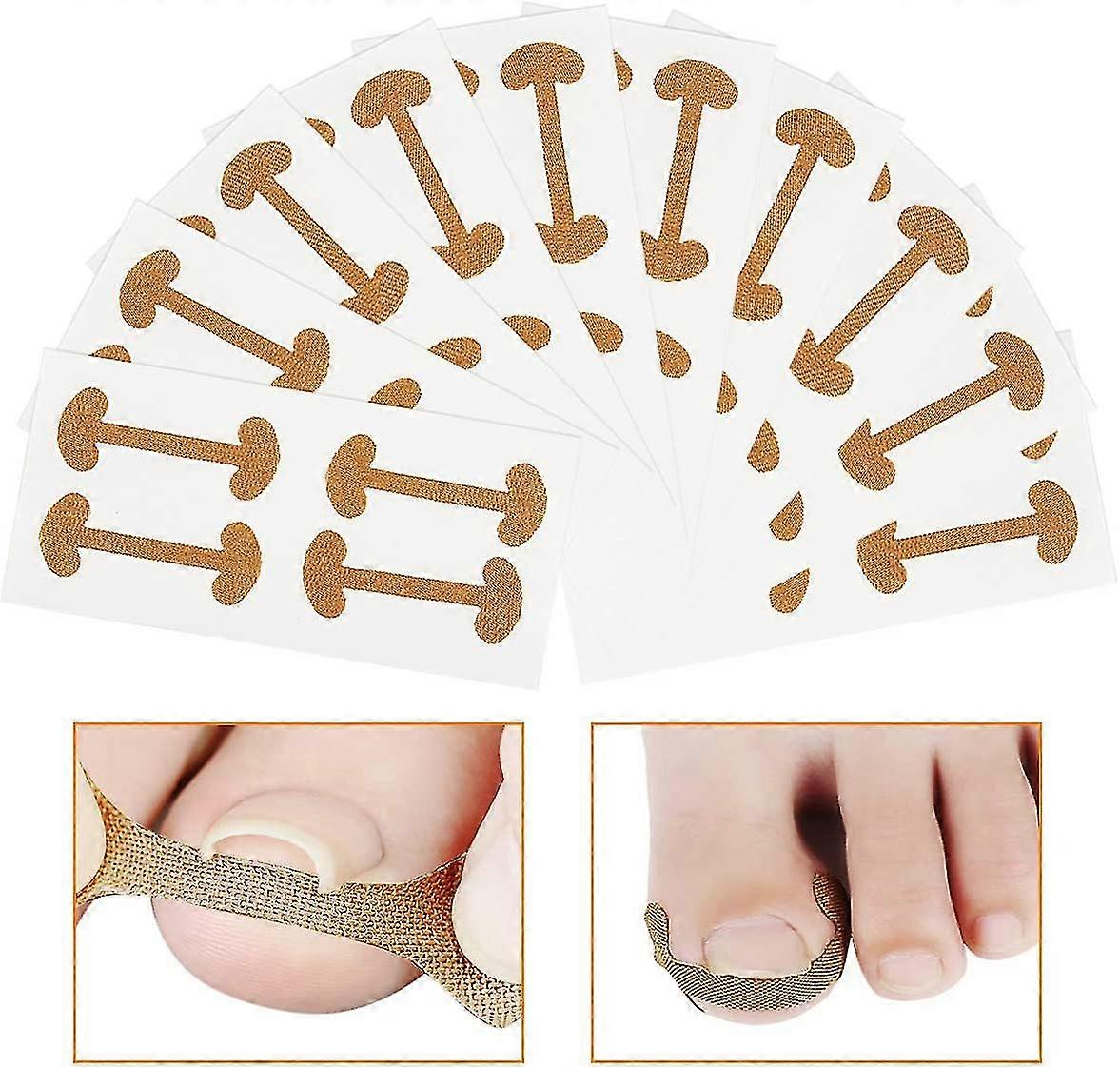 40 Pcs Ingrown Toenail Corrector Stickers Breathable Self-adhesive Elastic Toenail Correction Patch