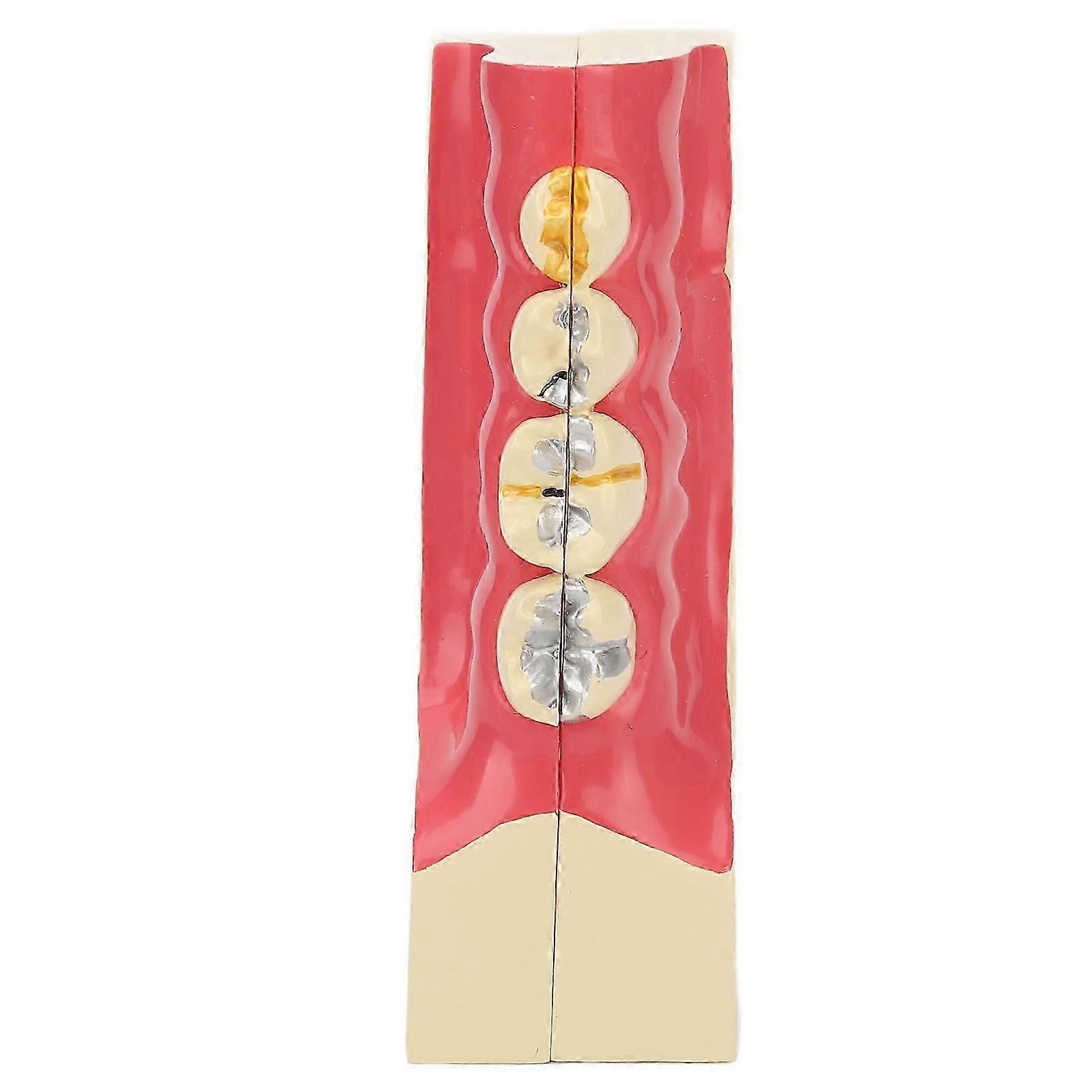 Right Lower Posterior Tooth Model 2X Magnification Detachable Resin Tooth Display Model