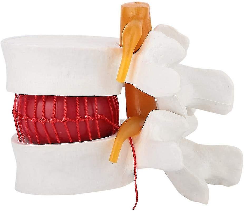 人体解剖学、1:1.5腰椎椎椎椎モードのヒト腰椎椎間板ヘルニアデモンストレーションモデル