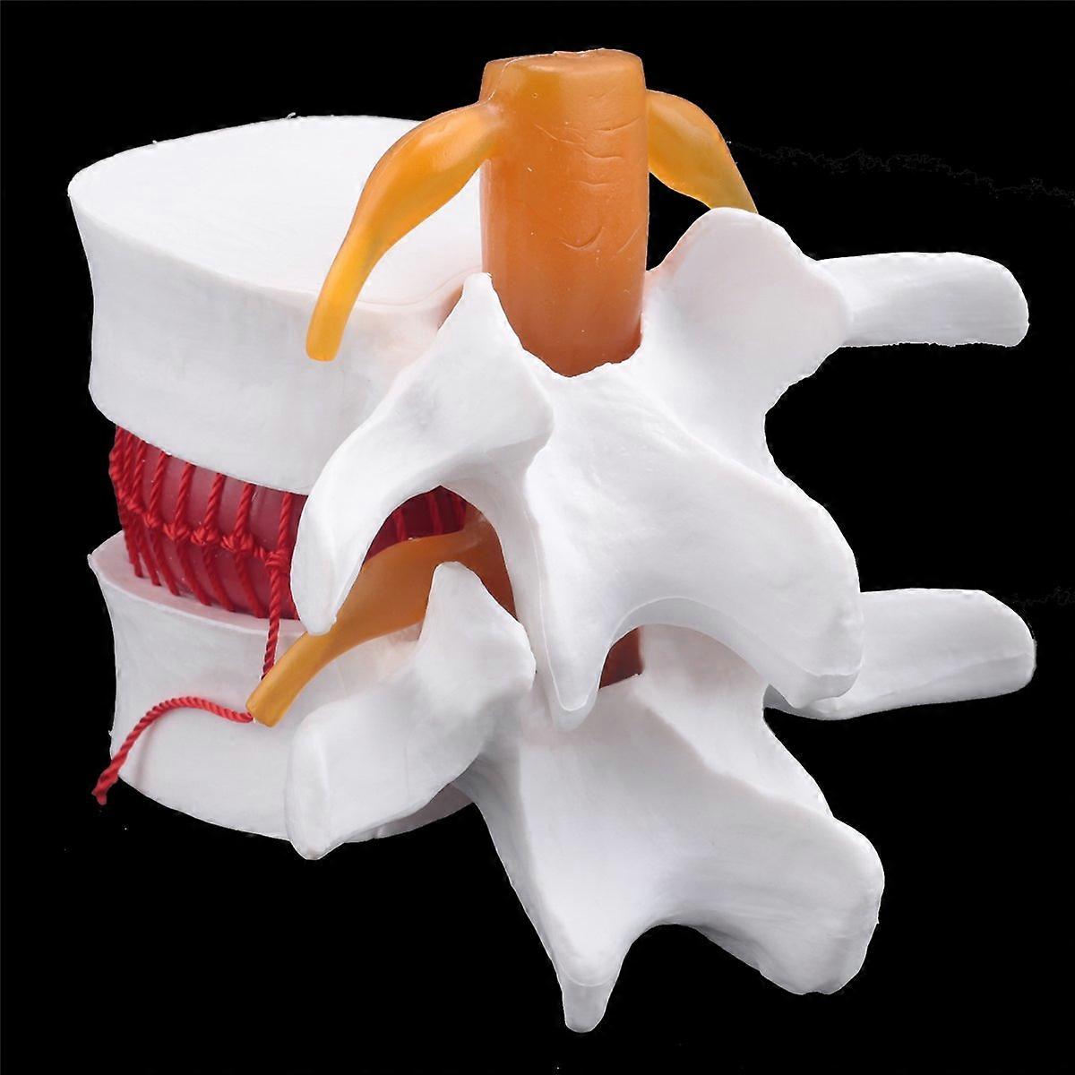 Human Anatomy Skeleton Spine Lumbar Disc Herniation Teaching Model