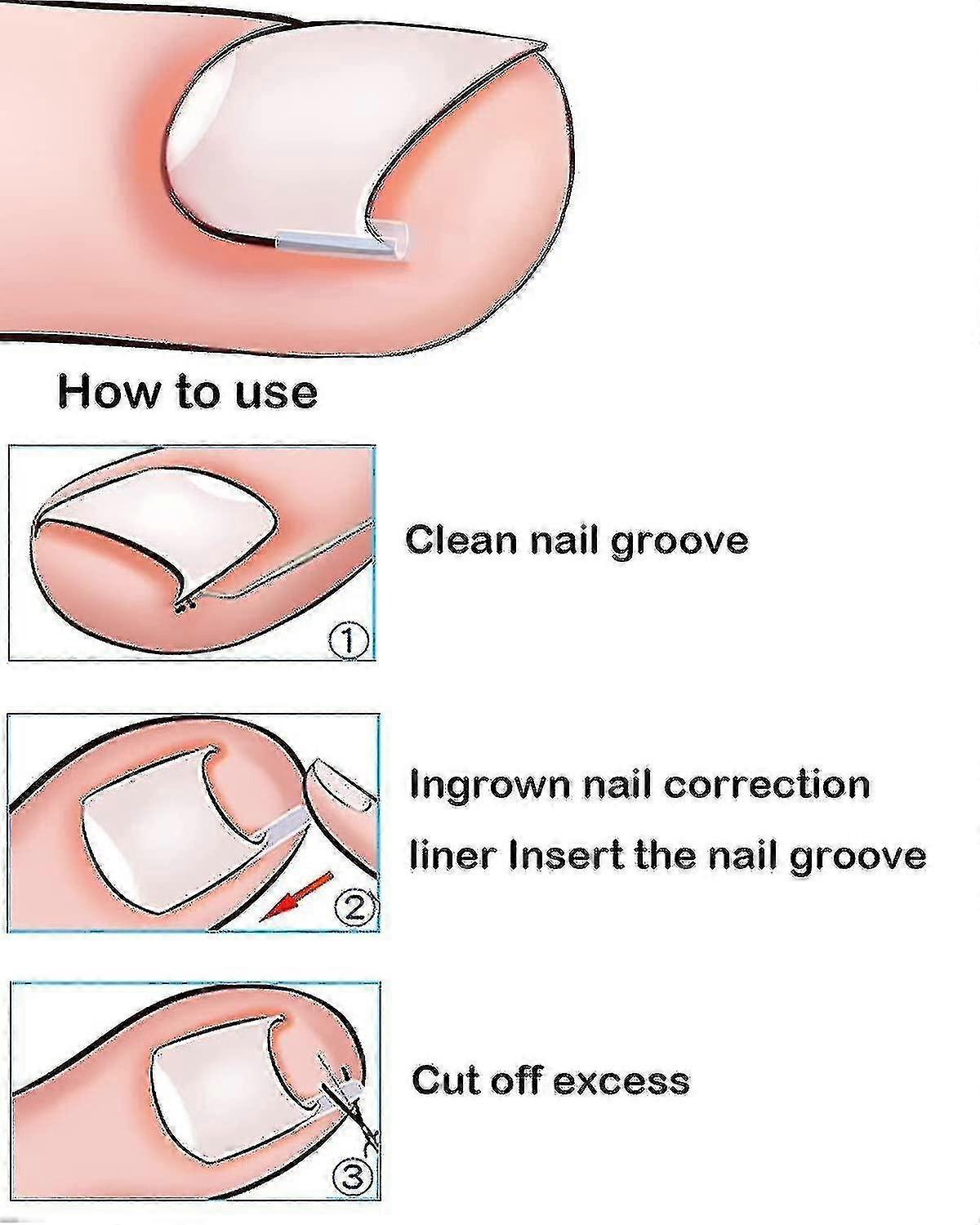 Professional Ingrown Toenail Correction