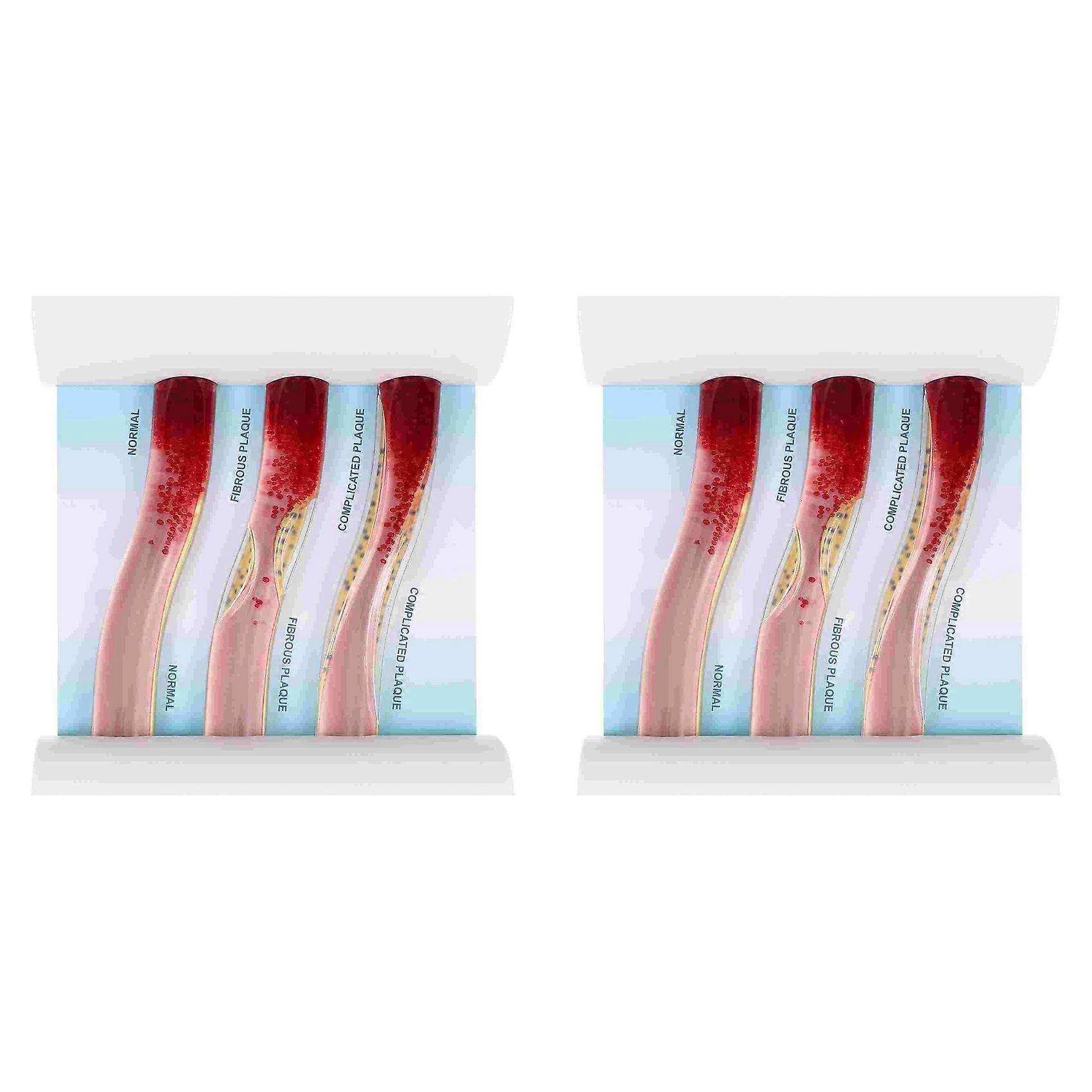 2X Dynamic Blood Vessel Model Cardiovascular Blockage Contrast Model Thrombosis Model for Teaching Explanation