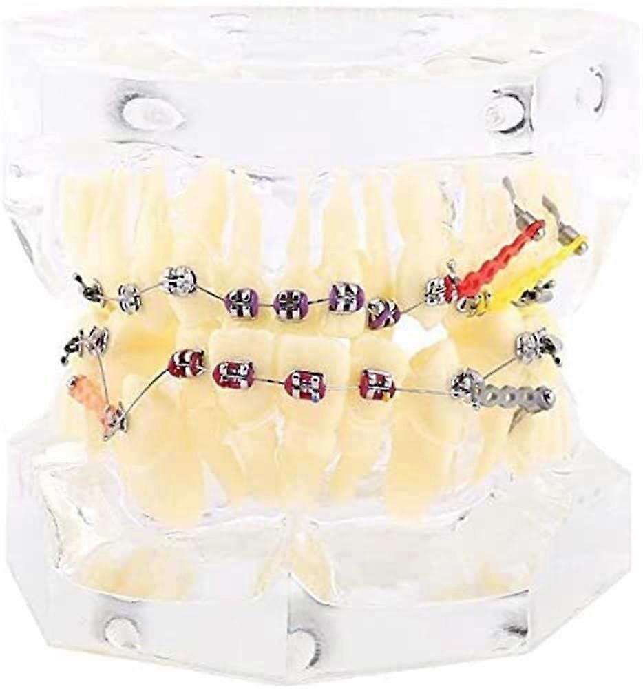 Orthodontic Malocclusion Study Teeth Model with Transparent Gingiva and Colourful Brackets