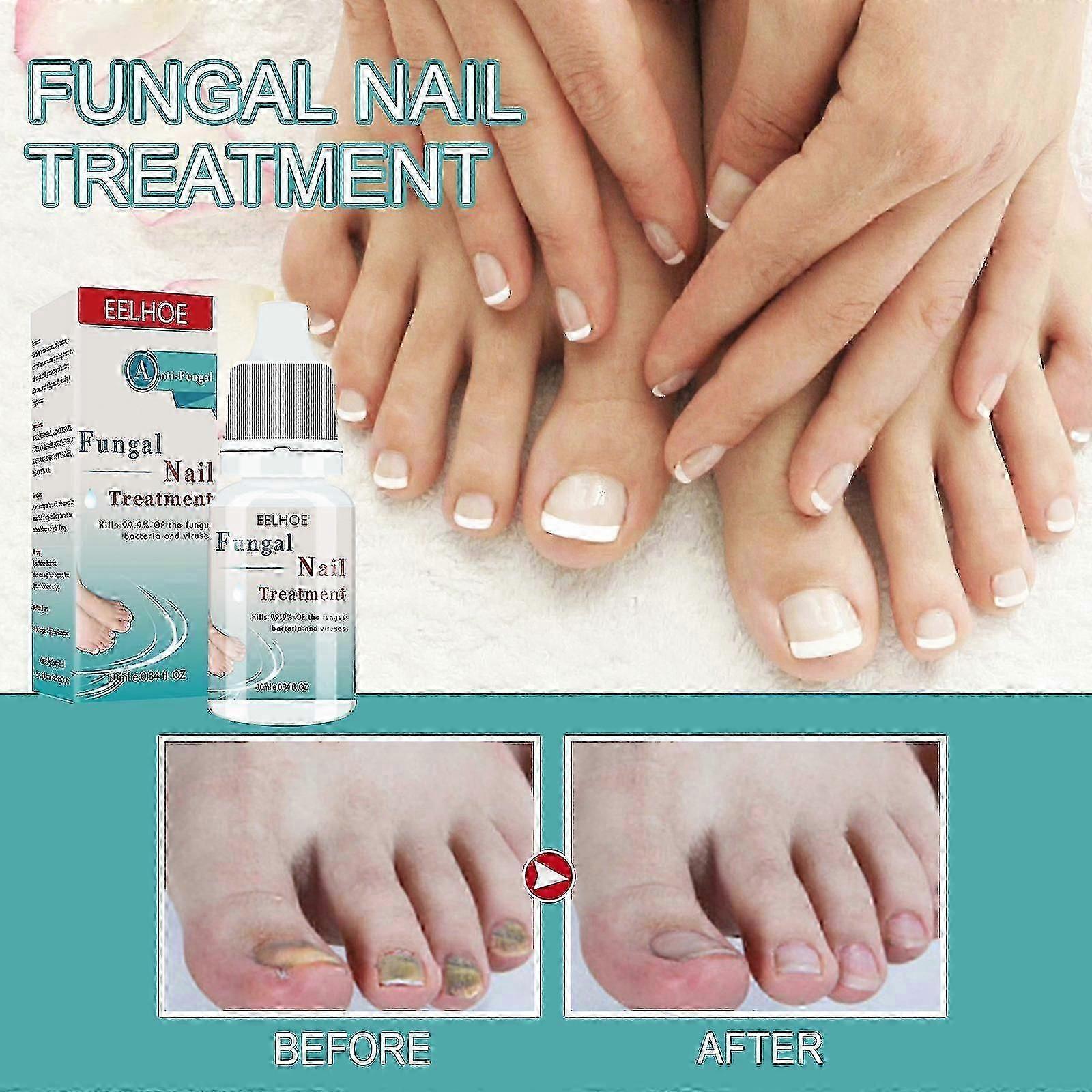 EELHOE菌類ネイルトリートメントリキッドネイルリペア保湿アンチハングネイルケアソリューションキューティクルクレ