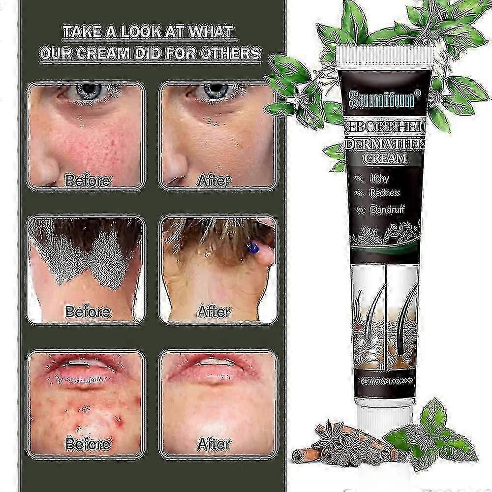 2025 Treatment Of Psoriatic Seborrheic Dermatitis Cream Head Acne Pruritus Scalp Ringworm Repair Skin Cleansing Cream Hair Scalp Care Db