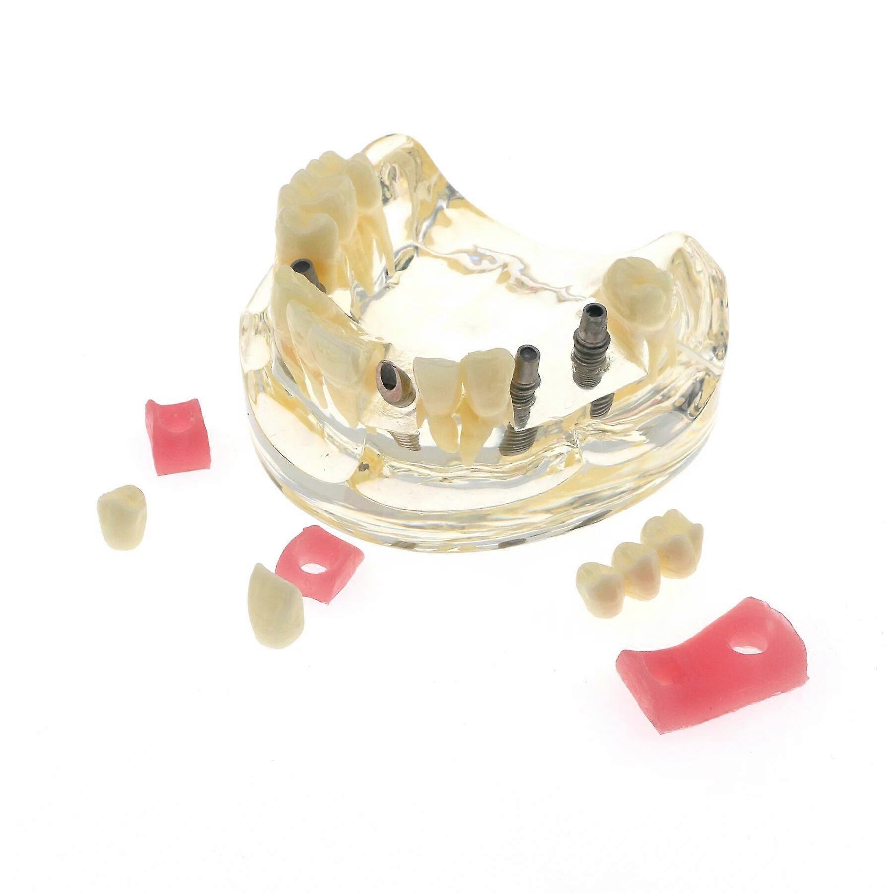 Model zębów dentystycznych z modelem implantu Most i próchnica uczą modelu badawczego M2005