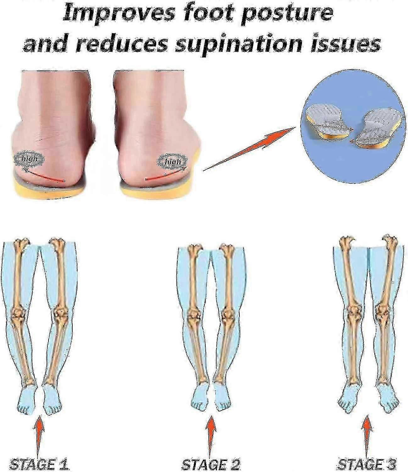 Supination Insoles For Over Supination & High Arch Support,orthotic Inserts For Foot Alignment, Knoc Tw