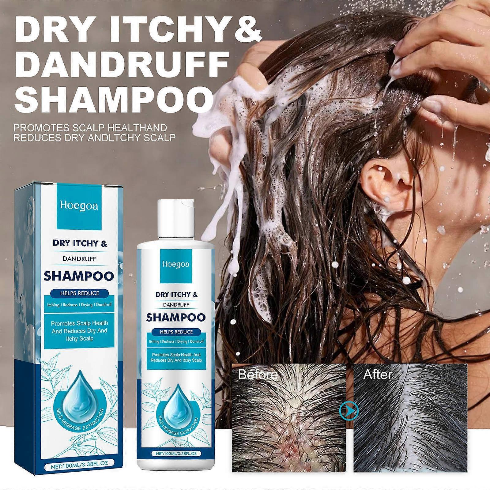 Light Unbrand Seborrheic Dermatitis Psoriasis Shampoo-Scalp For Folliculitis Psoriasis Dry Itchy Scalp Oily 100Ml 2Pcs