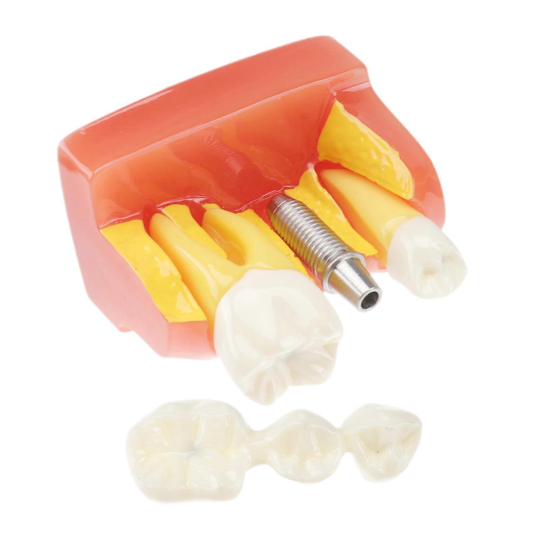 4x Enlarged Dental Teeth Model with Removable Teeth for Anatomy Study and Dentistry Training