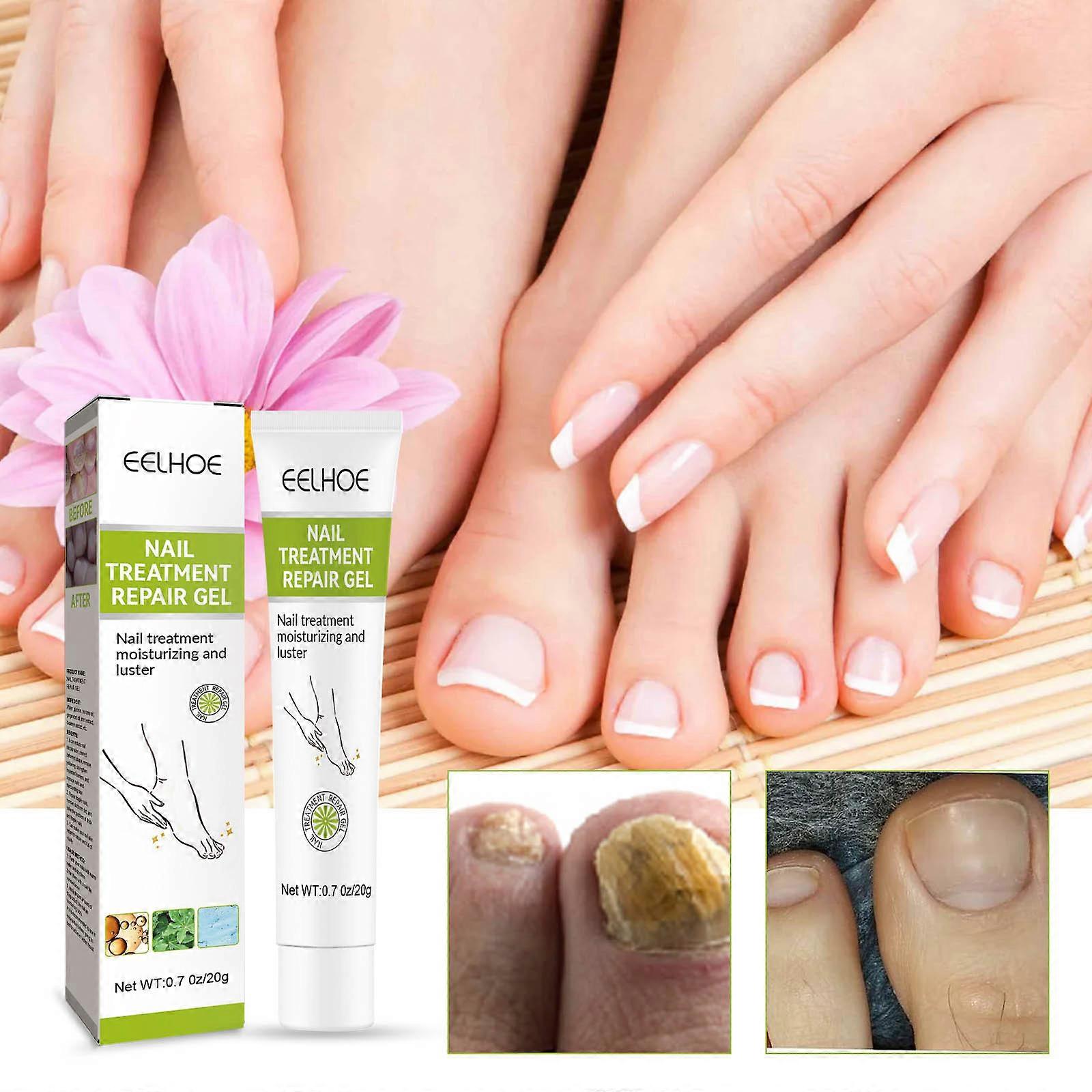 Gel de Cuidados com os Pés para Unhas Clareamento Remoção de Unhas Reparo