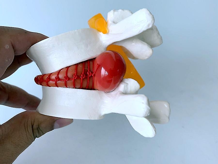 Human Spine Model Vertebrae Lumbar Intervertebral Disc Model Vertebral Body Model Protrusion Compression Pathological NIUNIU