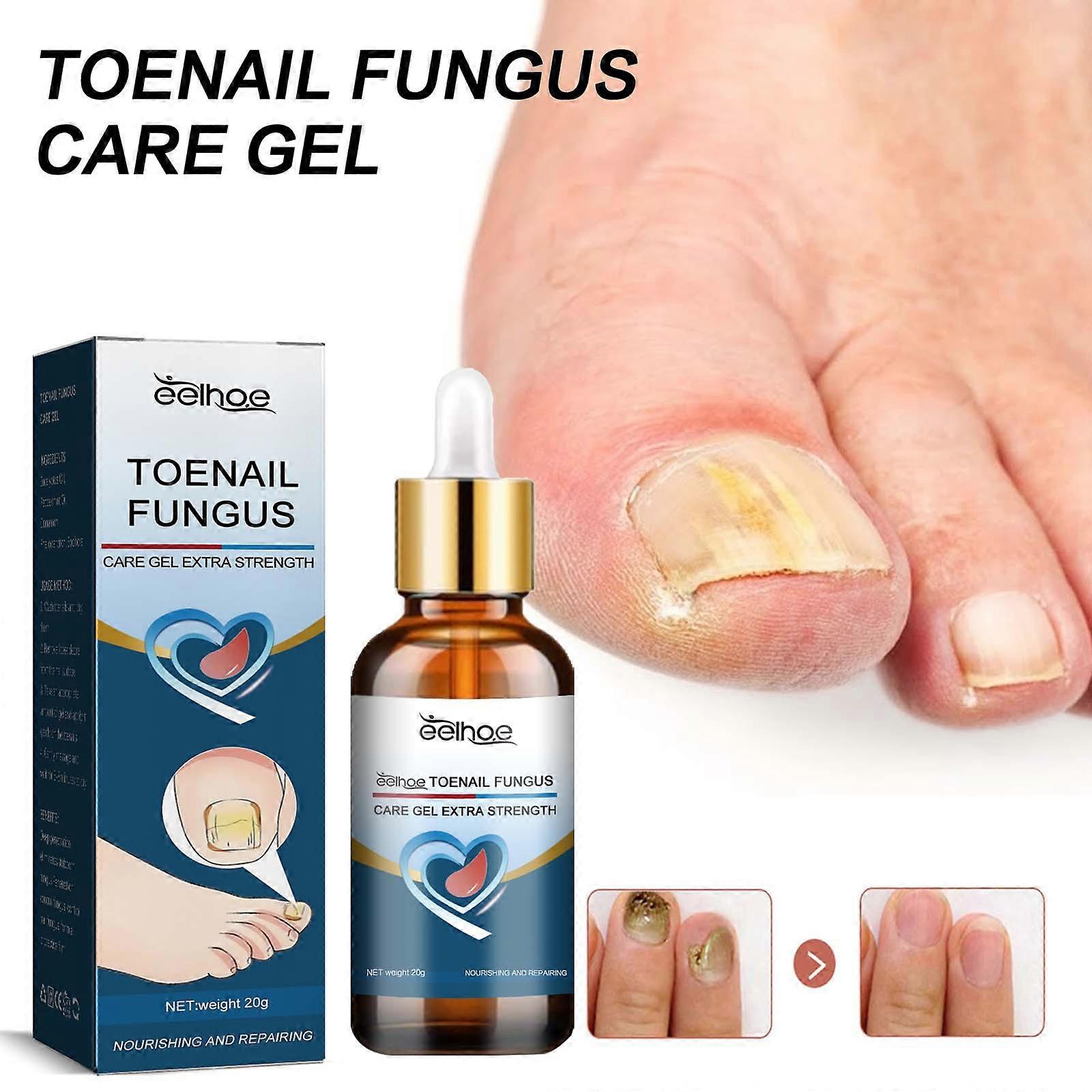 Toenal Care Gel, A Life, No Need To Worry About Toenail Deformation Or Odor 20ml FLYE4583