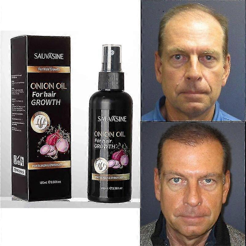 Huile d’oignon pour la croissance des cheveux Repousse Anti chute de cheveux Prévenir l’amincissement des cheveux Réparation des cheveux secs Cheveux abîmés Traitement des soins 100ml TW