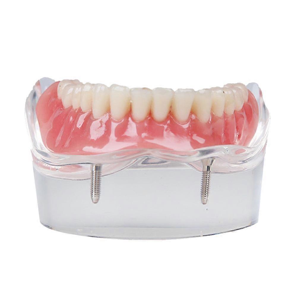 Implant Restroration Model Overdenture Inferior with 4 Implants