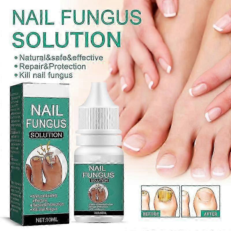 足の爪に強力な真菌性爪治療、陥入爪治療用ネイルケアオイル、足の爪白癬治療
