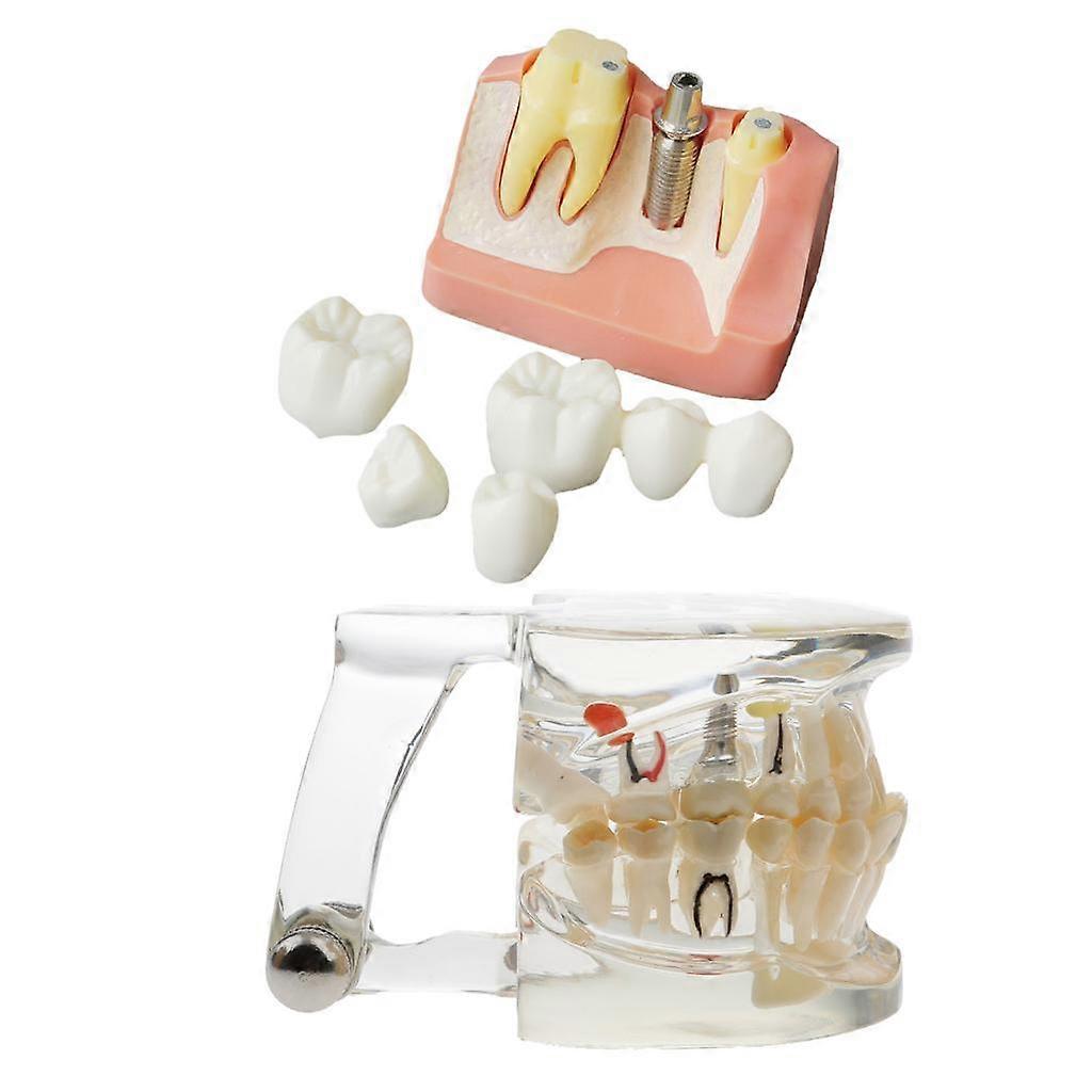 Dental Implant Teeth Model+ Dentist Equipment Analysis Bridge Demonstration