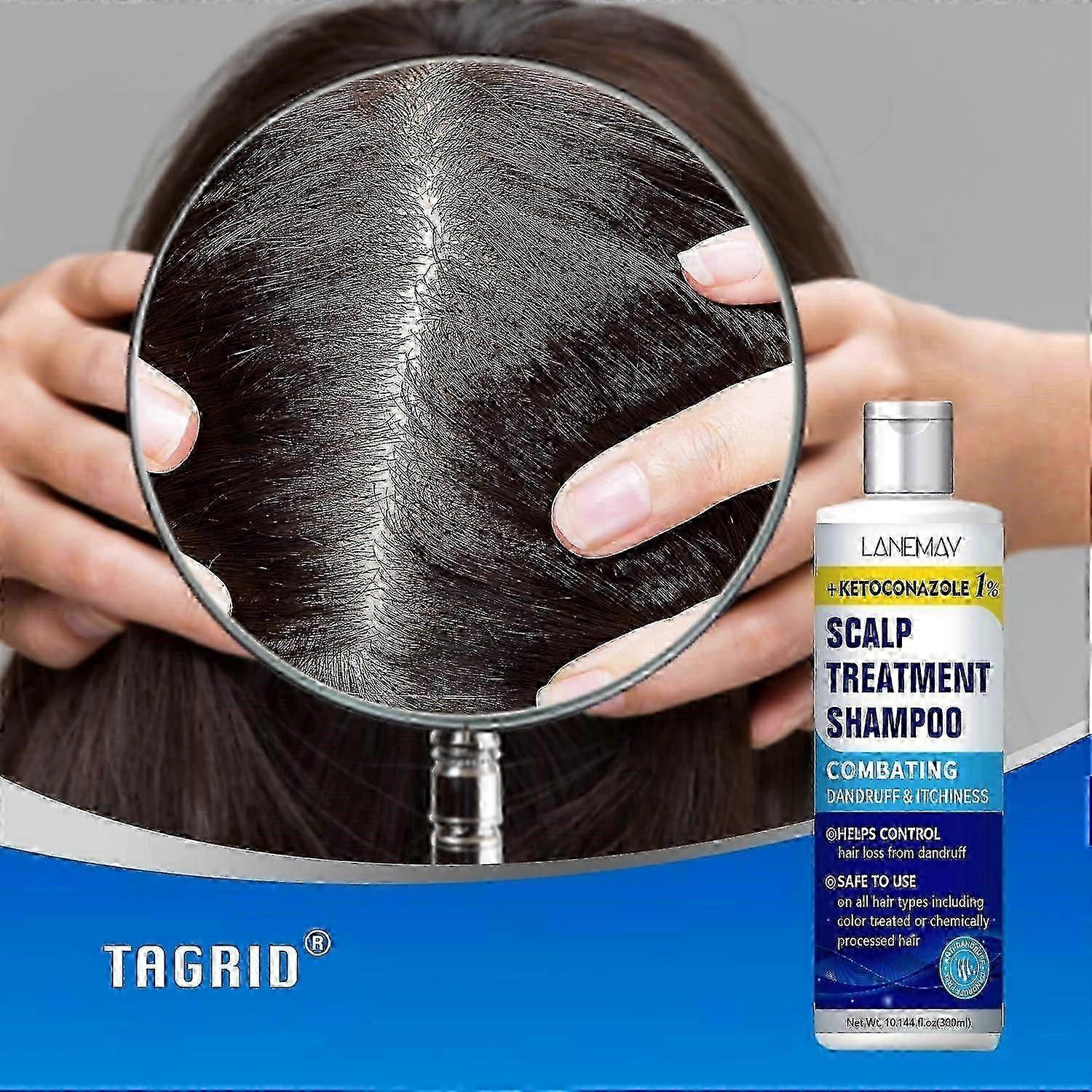 Ketokonazol Scalp Treatment Shampoo - Proti lupům šampon - Svědění pokožky hlavy úlevu, seboroická dermatitida, léčba folikulitidy, lupénka šampon -