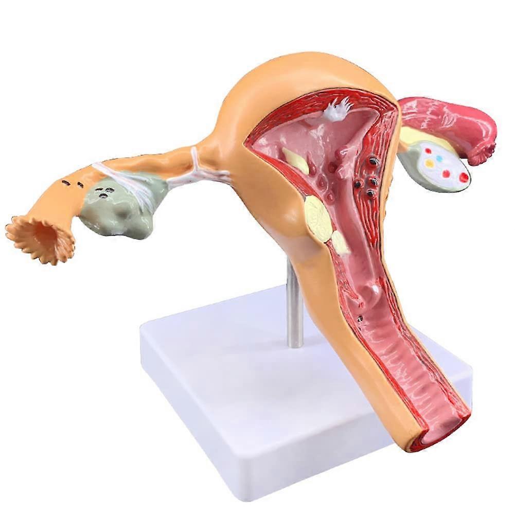 Uterine Ovarian Pathology, Anatomical Model, Female Reproductive System, Teaching Aid