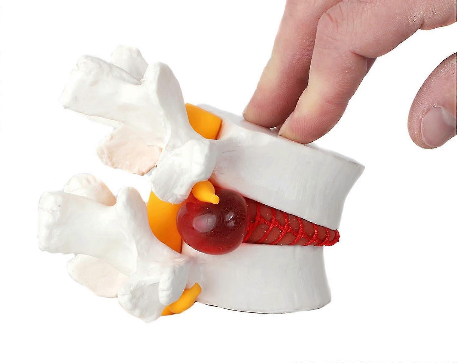 Human Lumbar Herniating Disc Demonstration Anatomy Model For Teaching And Learning