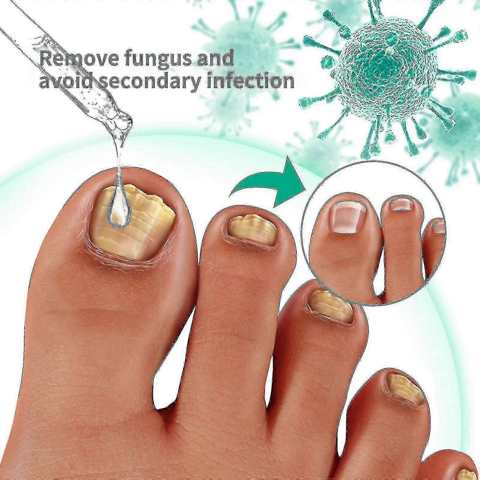 Toenail Repair Liquid Hand And Foot Thickening Type Gray Nail On