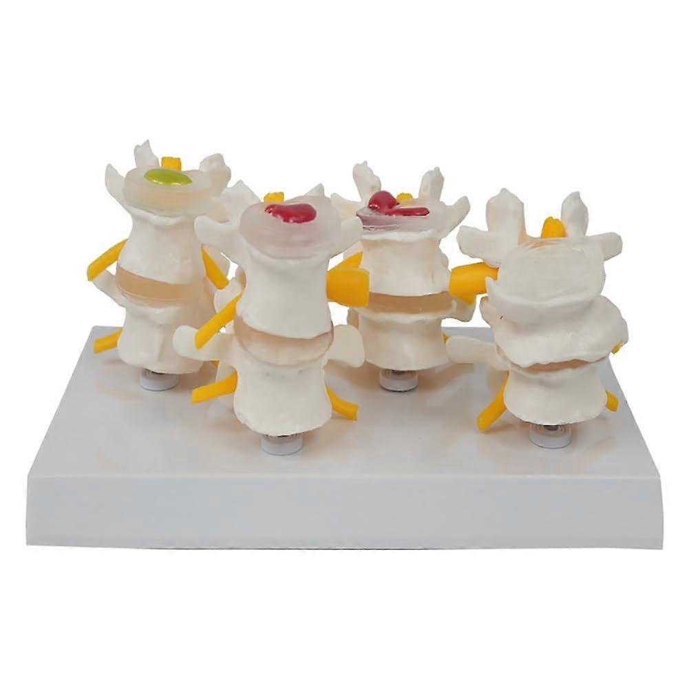4 Stages Lumbar Spine lesions Comparative Model