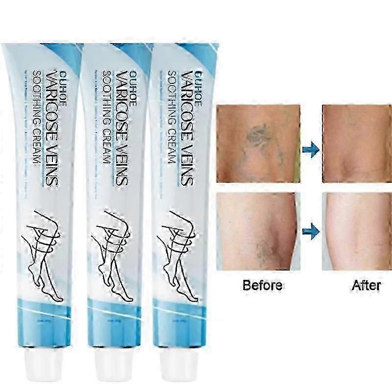 1-3xクモ状静脈修理クリーム、脚の静脈瘤治療、脚の痛みの脚の救済のための静脈クリーム、脚の静脈瘤用クリーム
