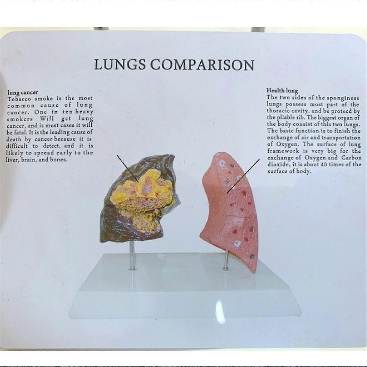 Smoker'S Lung Model Healthy Lung Model Lung Anatomy Model