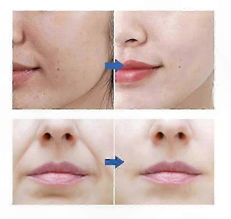 30-Pack Microcrystalline Anti-Wrinkle Mask for Nasolabial Folds and Face Lifting