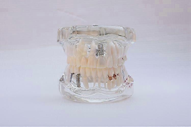Dental Teaching Model - Single Piece Implant & Bridge Demonstration Tooth With Brackets 9 thumbnail image
