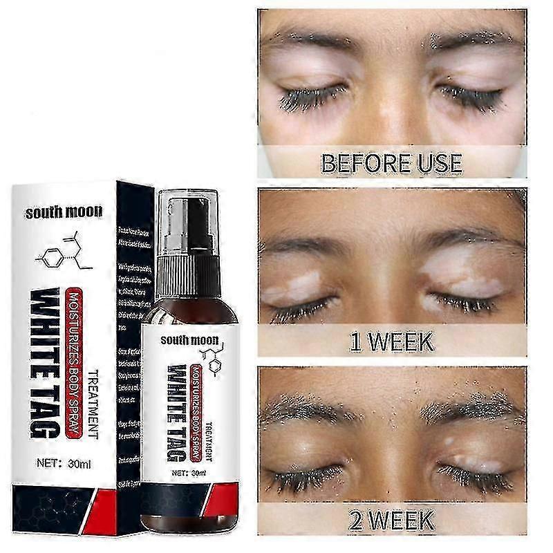 بخاخ البهاق ، علاج البهاق للبهاق الجلدي ، بخاخ العناية بالبهاق لتقليل البقع البيضاء