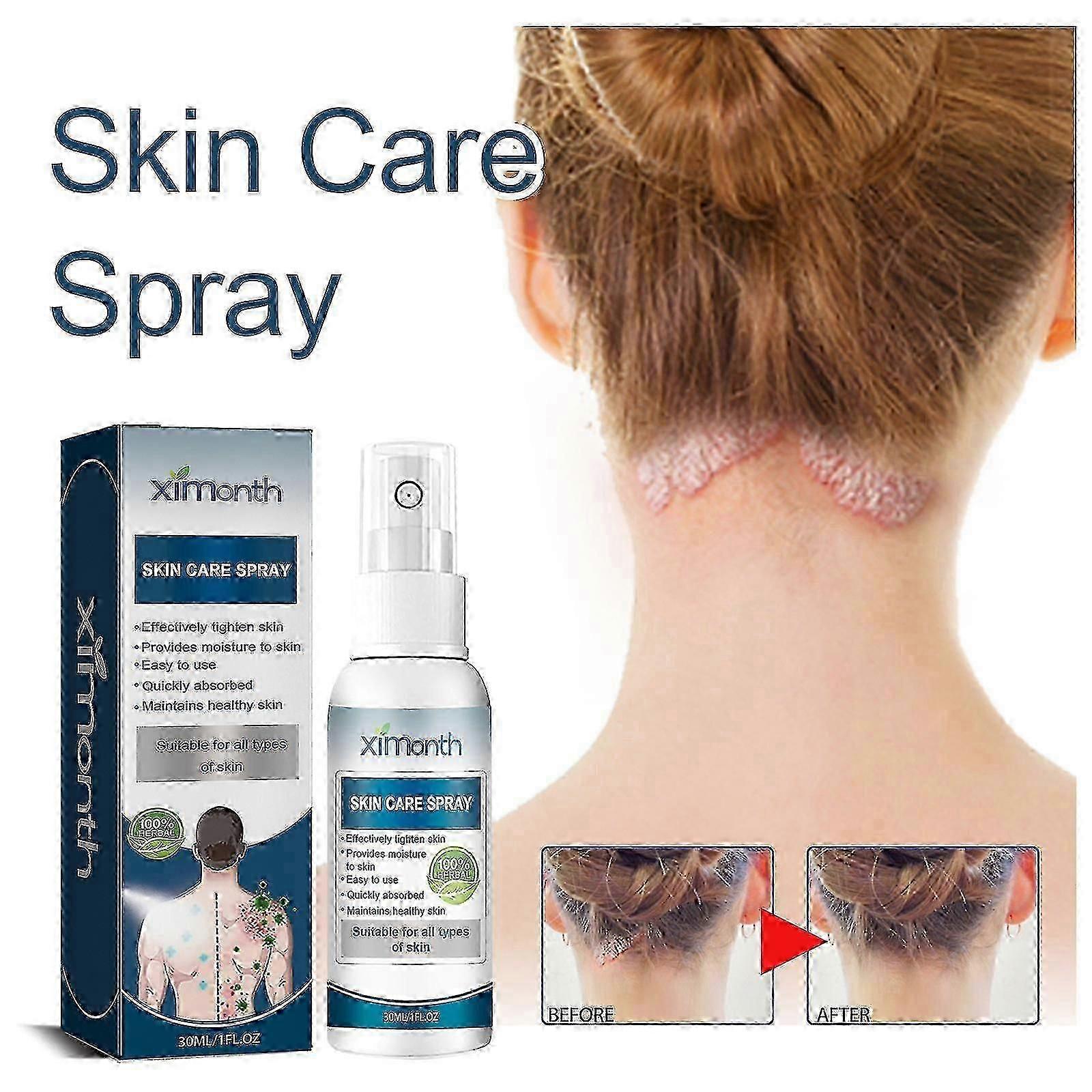 乾癬治療スプレー頭皮回復療法、頭皮乾癬治療スプレー、皮膚回復乾癬コントロール保湿スプレー