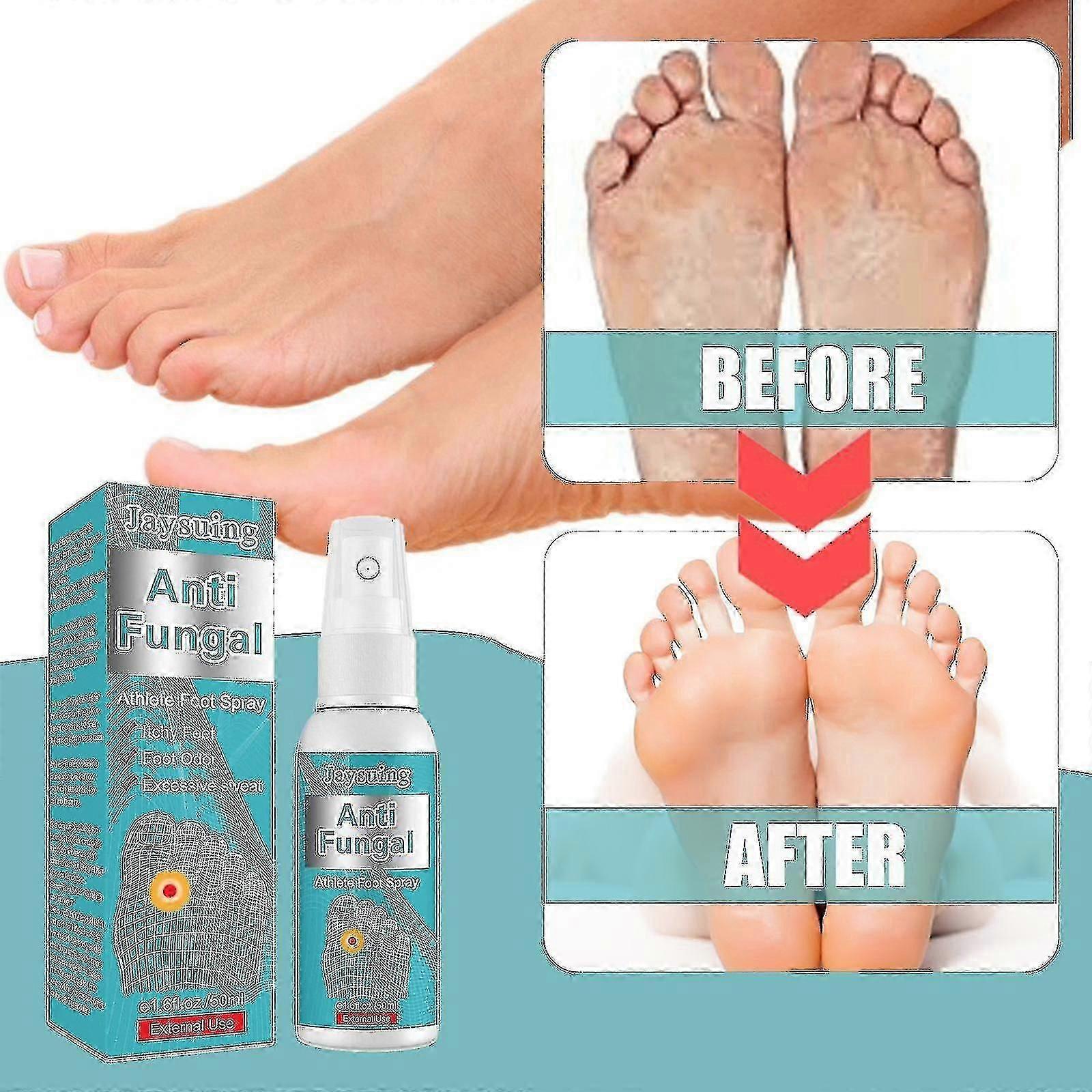 Jaysuing Athletes Foot Dezodor Spray javítja a büdös izzadt lábakat Rothadt lábak megállítják a viszkető dezodor spray-t