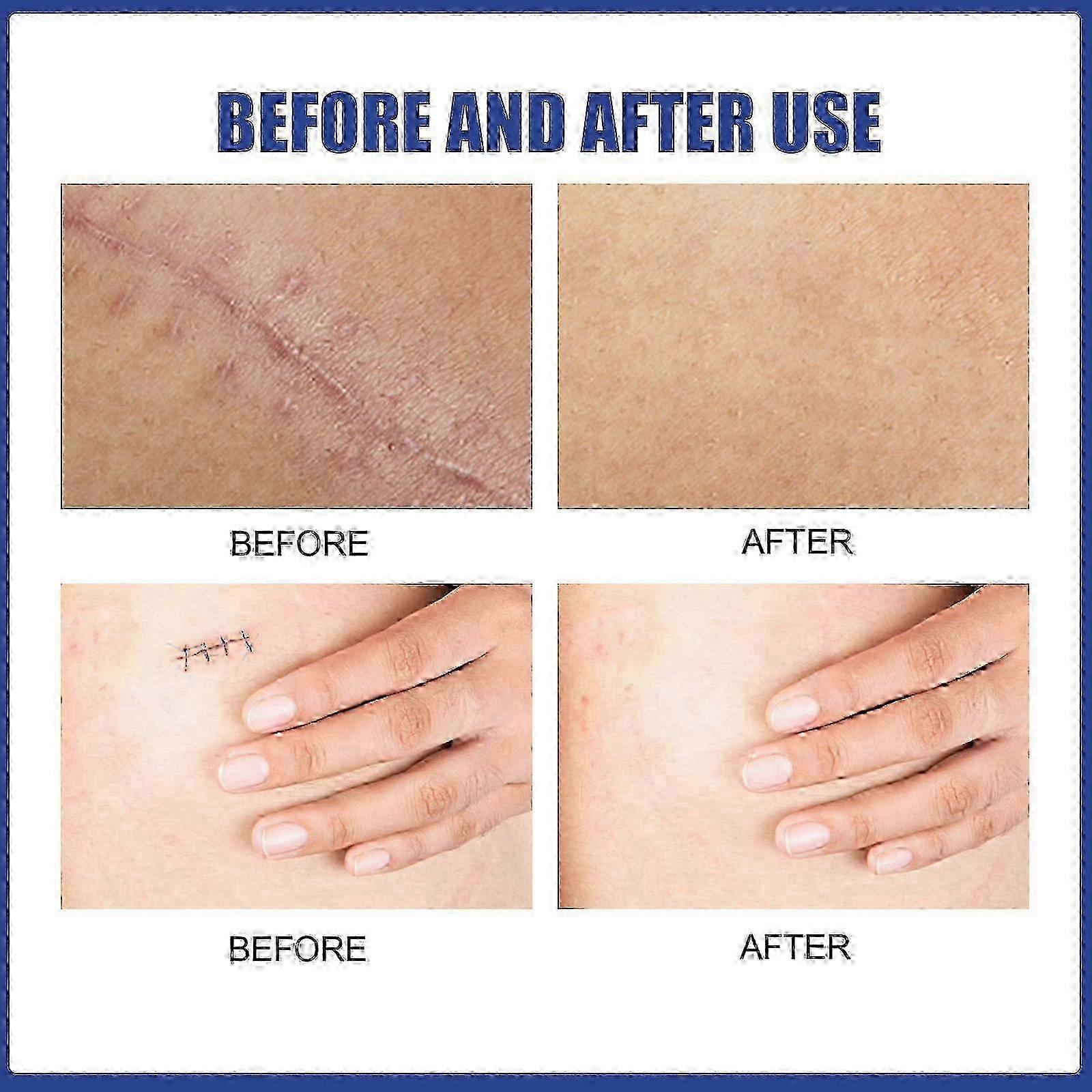 Breast-Specific Silicone Scar Strips