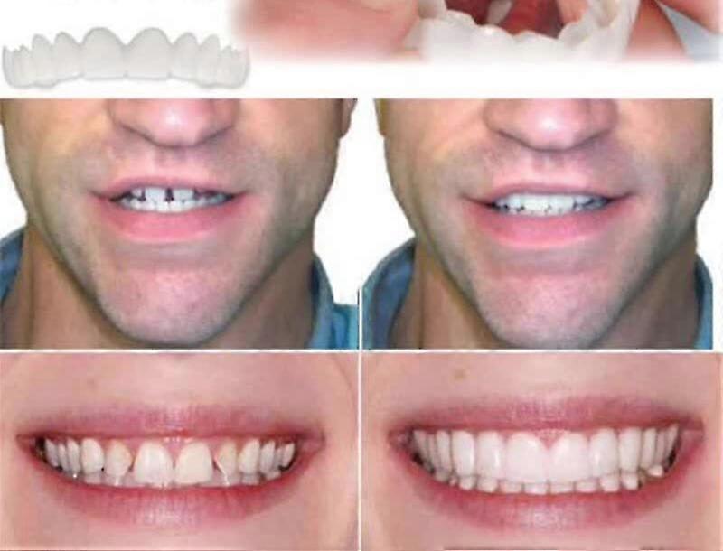 Perfect Smile Veneers Comfort Fit - Flex Denture Paste Braces