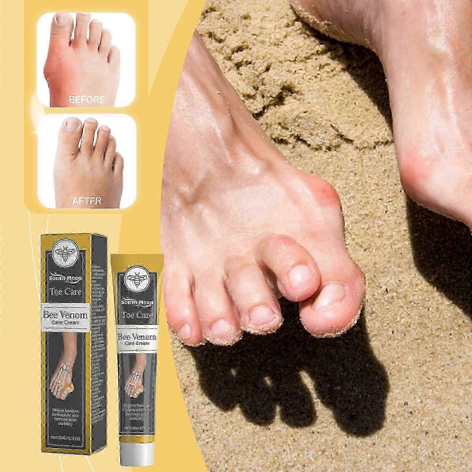 קרם טיפול בוניון ארס דבורים, תמיכה Hallux Valgus פטיש בוהן הקלה על כאבי דלקות, קרם טיפול BeeVenom Hallux Valgus מתקן