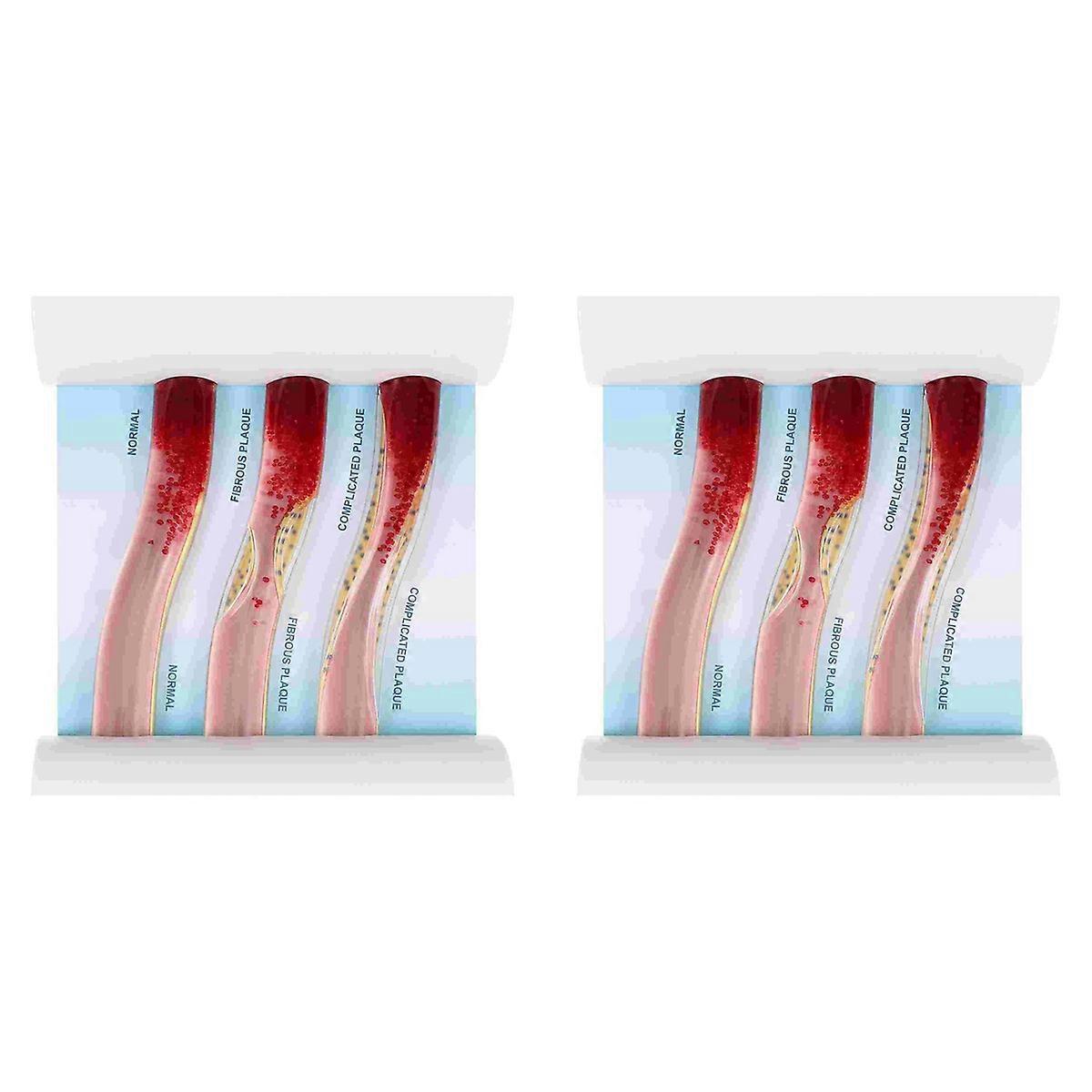 Dynamic Blood Vessel Model Thrombosis Model for Teaching Explanation