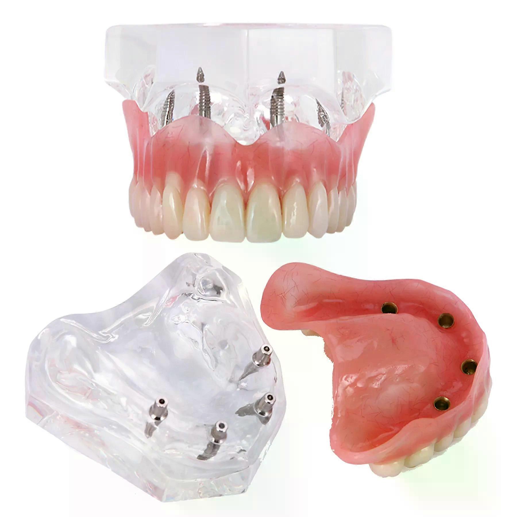 ntistry Teeth Model With Clear Upper 4 Implants Overdenture Restoration Model For Dentist Explain Overdenture Functioning