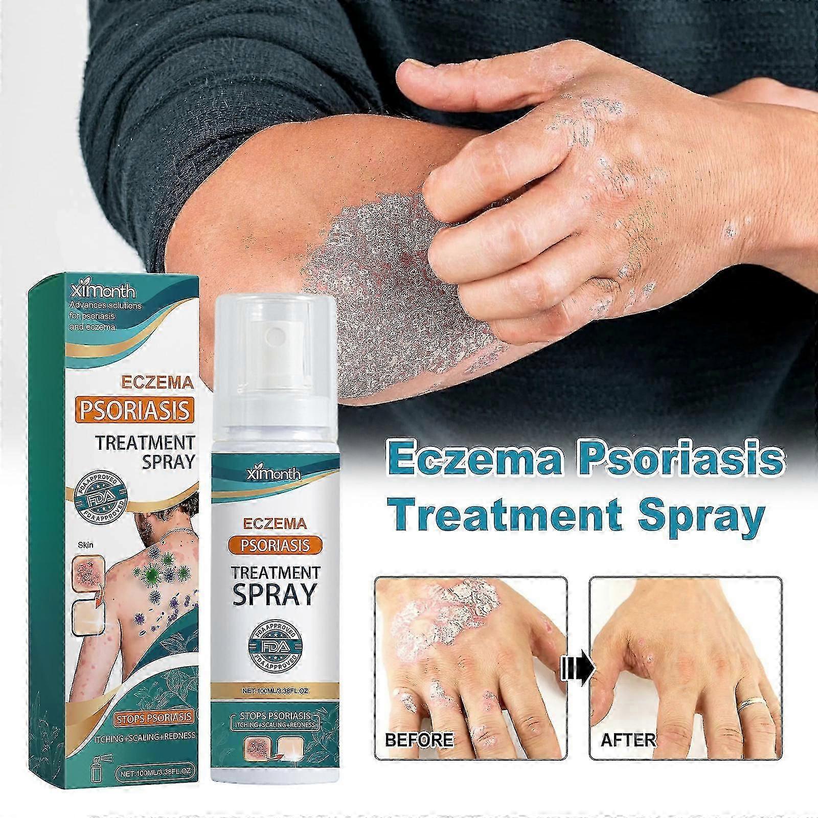 بخاخ علاج الصدفية الأكزيما ، رذاذ تخفيف الصدفية العشبية رذاذ تخفيف الأكزيما رذاذ علاج الصدفية البهاق رذاذ إصلاح الجلد