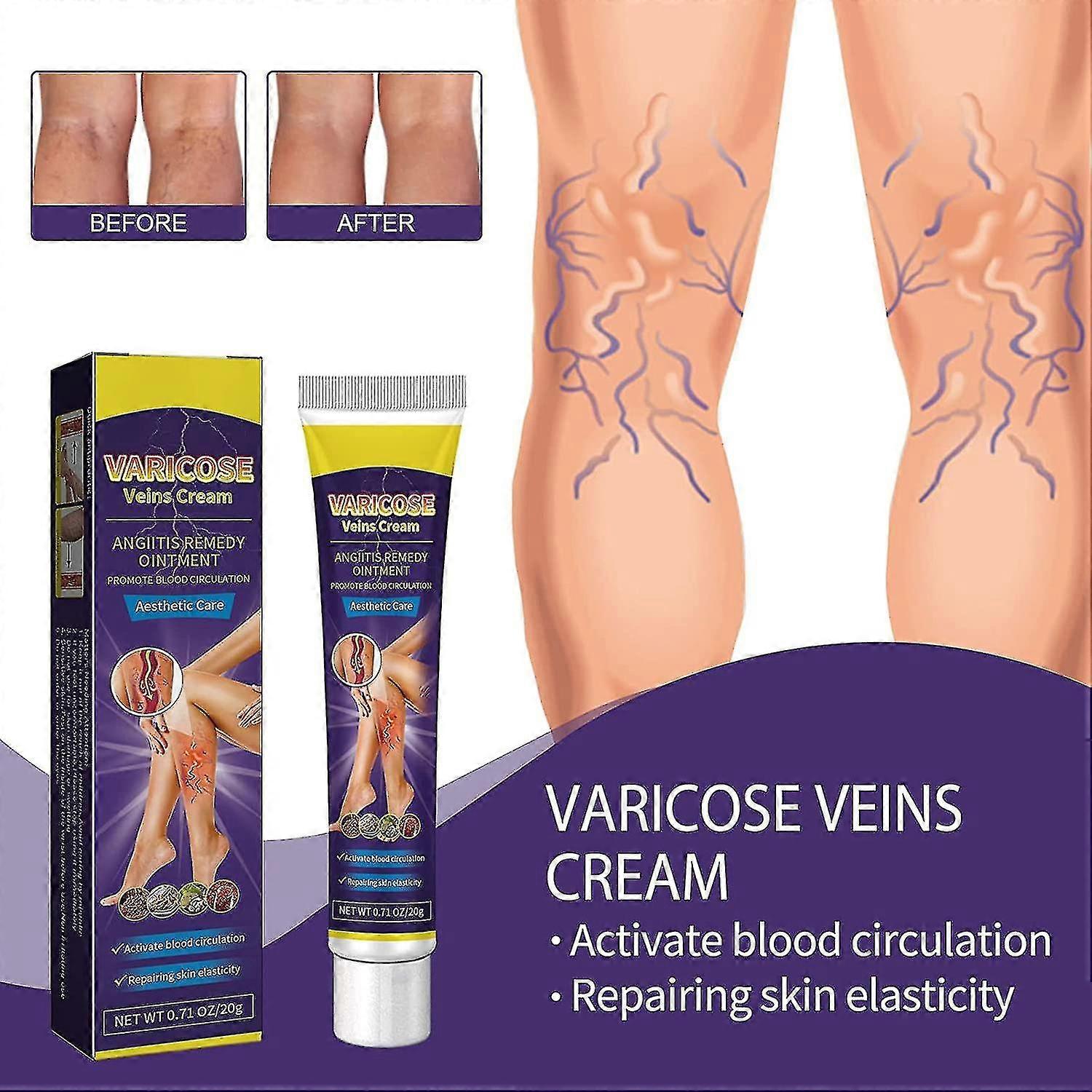 Varicose Vein Cream, Relief Of Leg Varicose Veins, Strengthening Capillary Health, Spider Vein Care Cream