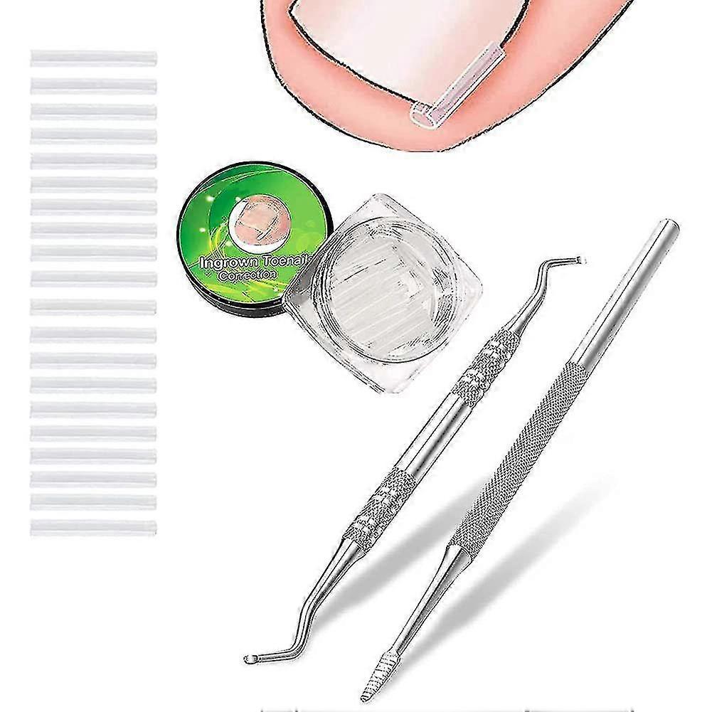 (50+2) Pack Professional Ingrown Toenail Correction Treatment Kit, 50 Pieces Ingrown Toenail Corrector Straightener With Restoration Entrainment 2 Pie