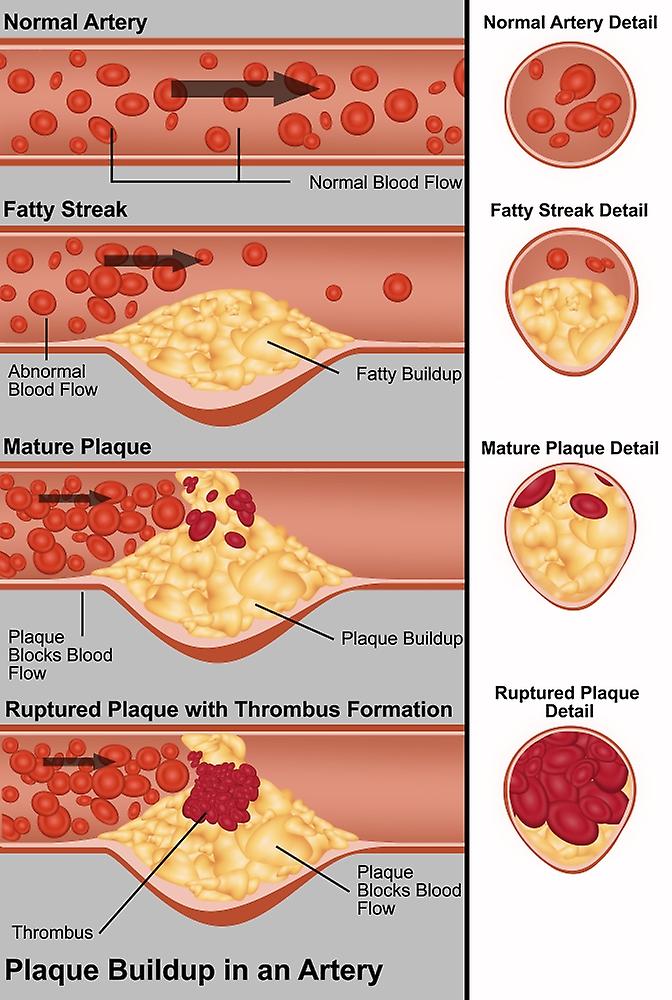 Plaque in Artery Poster
