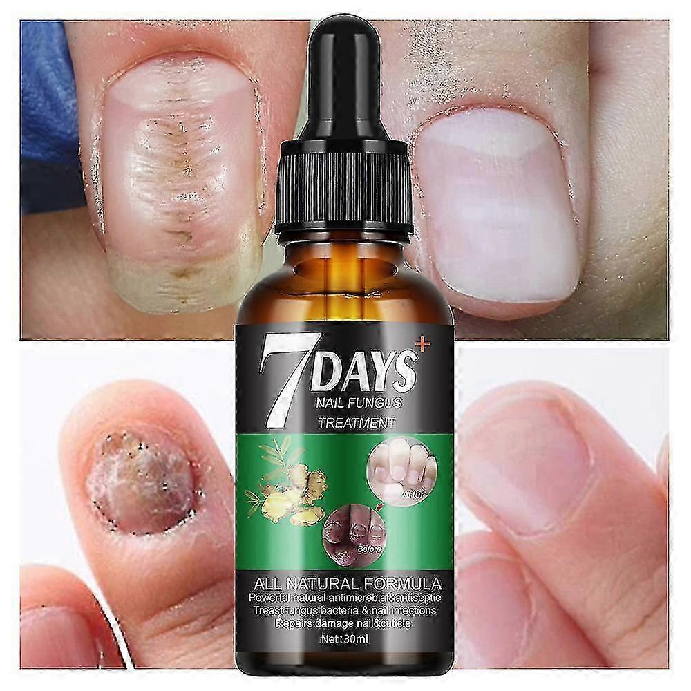 2025 7 jours de traitement des champignons des ongles, 7 jours de croissance des ongles et de renforcement des ongles, solution de réparation des ongl
