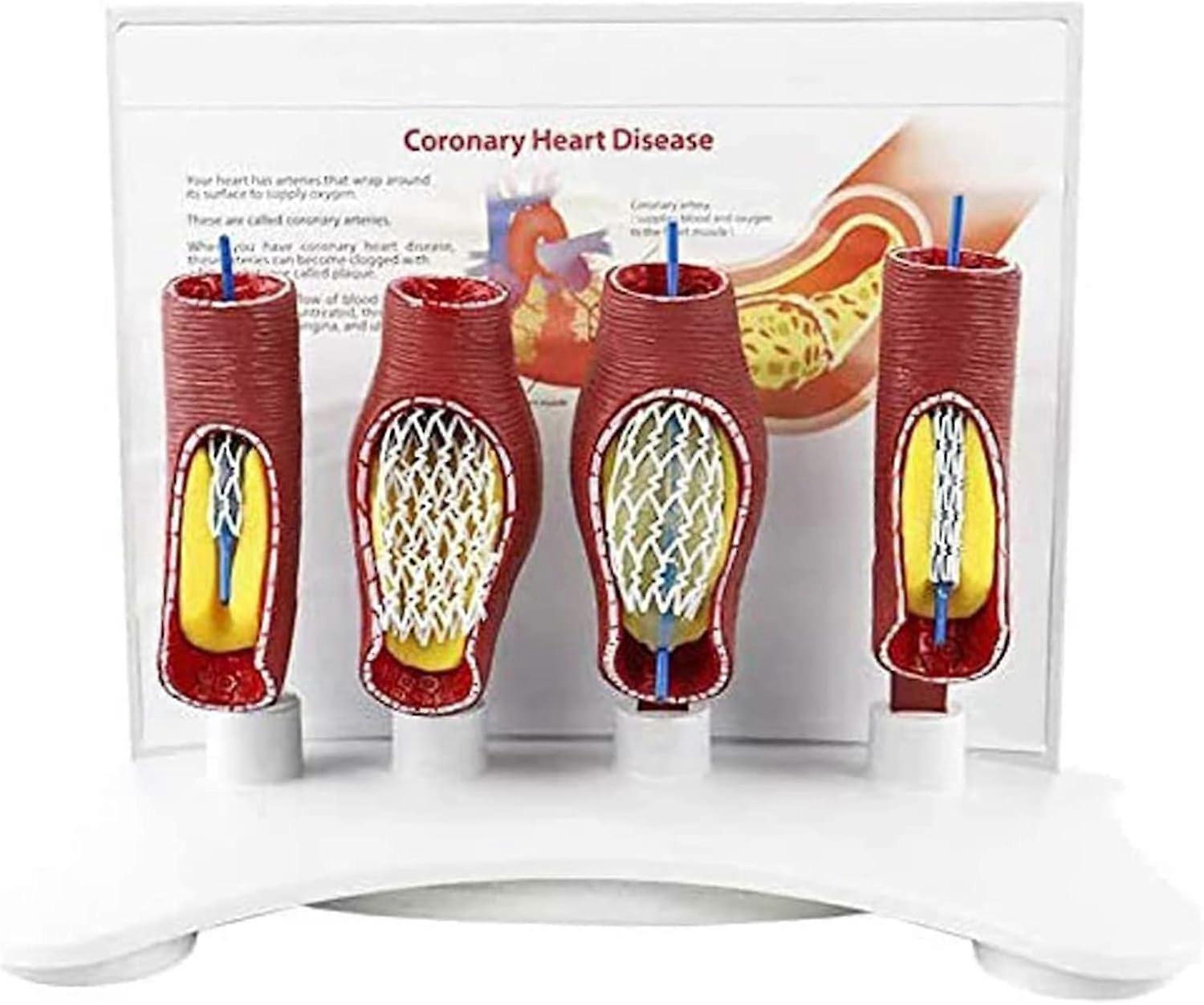 Vascular Stent Model with Enlarged Vascular Visualization, Realistic Stent Deployment Teaching Aid for Medical Training